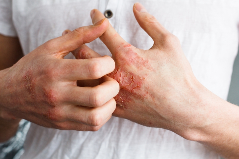scratch-eczema